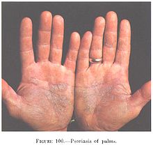 psoriase palmar mãos