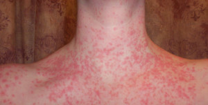 psoriase inflamação peito pescoço