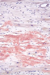 fibras depositos amiloide