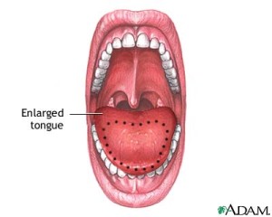 macroglossia