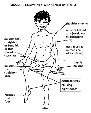 sintomas polio