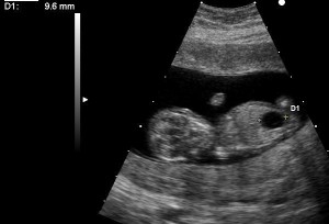 ultrasom sindrome down