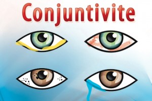 conjuntivite