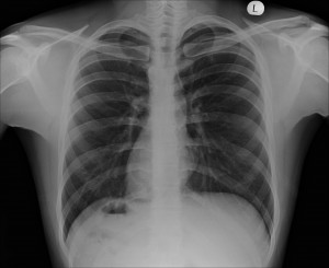 dextrocardia