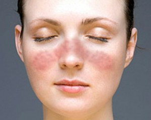 lupus inflamaçao borboleta cara