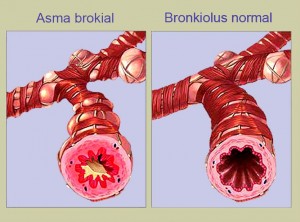 asma bronquios