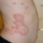 tinea corporis