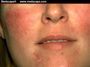 rosacea_medscape