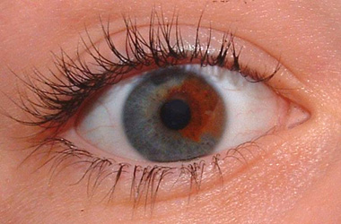 Heterocromia parcial