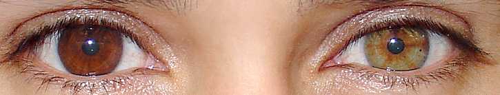 heterocromia total