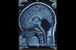 missing cerebellum