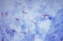 M. tuberculosis com coloração de Ziehl-Neelsen; ampliação 1000x