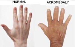 Diferença entre a mão de um indivíduo saudável (esquerda) e de um indivíduo com acromegalia (direita)