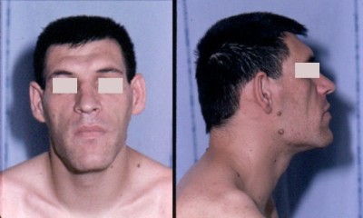 Traços faciais de um indivíduo com acromegalia. Crédito: Wikipédia