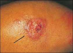 Lesão cutânea num paciente com leishmaniose cutânea. Imagem de Moiz et al. (6)