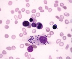 Amastigotas de Leishmania numa amostra de sangue. Imagem de Moiz et al. (6)