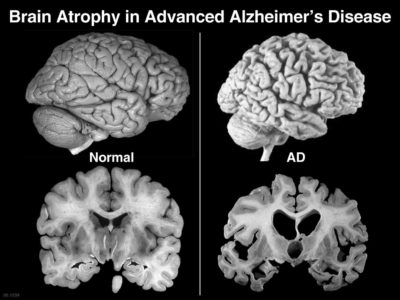 atrofia cerebral