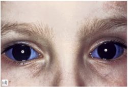 Esclera azulada numa criança com osteogenesis imperfecta