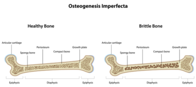Esquema representativo da diferença entre um osso saudável e de um osso de um indivíduo com osteogenesis imperfecta