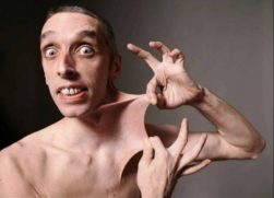 Gary "Stretch" Turner, um artista com a pele altamente elástica associada à síndrome de Ehlers-Danlos
